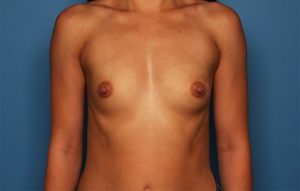patient before breast augmentation front view Sarasota Plastic Surgery