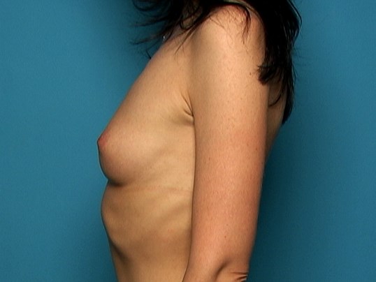 patient before breast augmentation sideview Sarasota Plastic Surgery