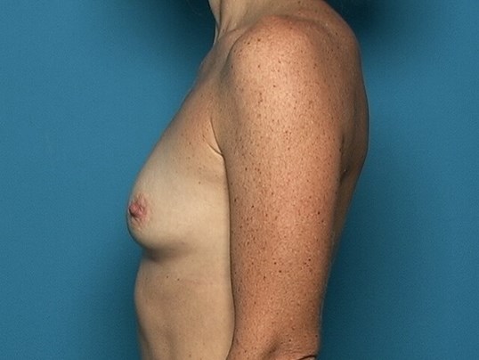 patient before breast augmentation side view Sarasota Plastic Surgery