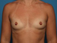 patient before breast augmentation front view Sarasota Plastic Surgery