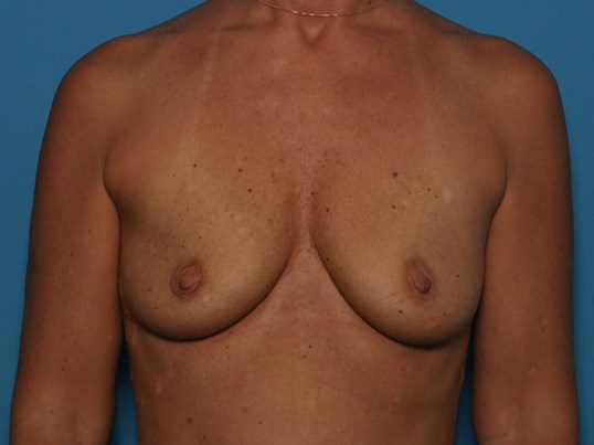 before breast augmentation front view