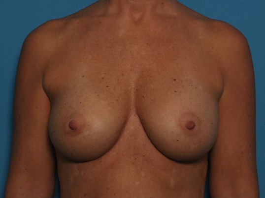 after breast augmentation front view