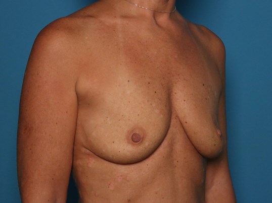 before breast augmentation diagonal view