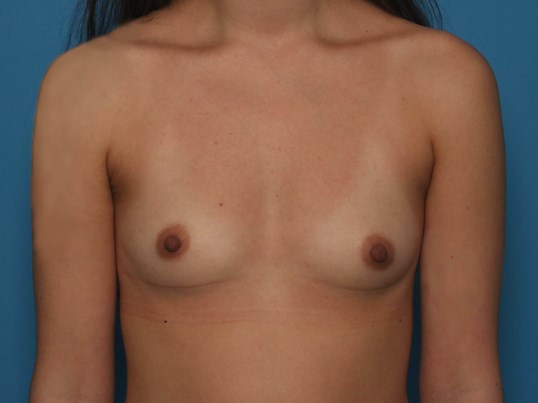 before breast augmentation front view
