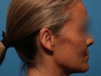 Sarasota ear surgery results