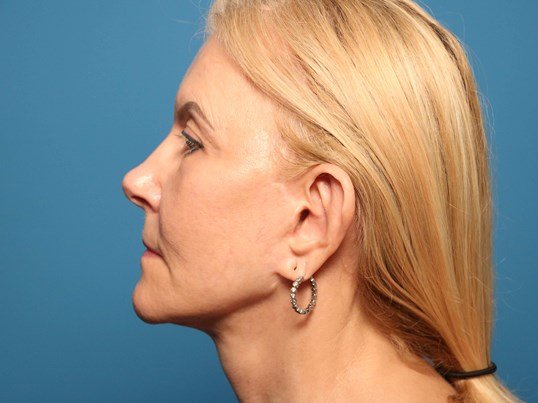 Sarasota ear surgery before