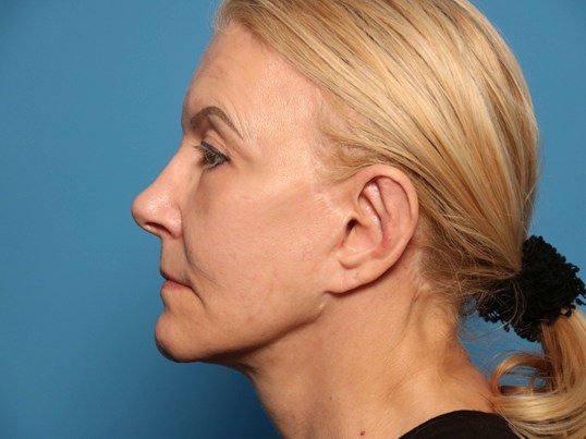 Sarasota ear surgery results