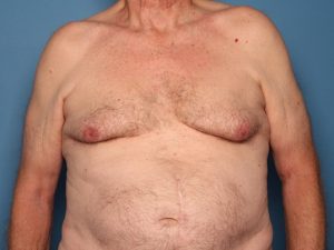 Sarasota gynecomastia surgery before