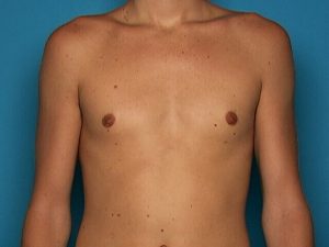 Sarasota gynecomastia surgery results