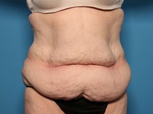 before tummy tuck front view sarasota plastic surgery