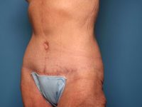 after tummy tuck diagonal view sarasota plastic surgery