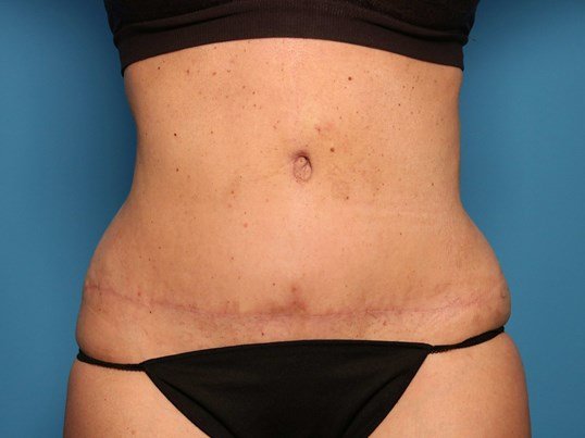 after tummy tuck front view sarasota plastic surgery