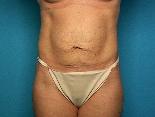 before tummy tuck front view sarasota plastic surgery