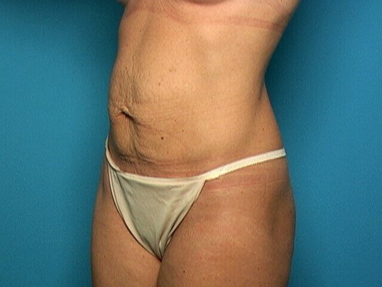before tummy tuck diagonal view sarasota plastic surgery
