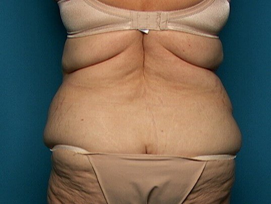 before tummy tuck back view sarasota plastic surgery