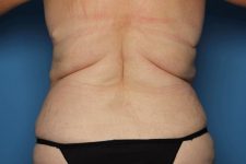 after tummy tuck back view sarasota plastic surgery