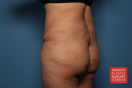 after tummy tuck back view sarasota plastic surgery