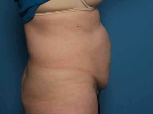 before tummy tuck side view sarasota plastic surgery