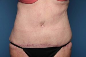 after tummy tuck front view sarasota plastic surgery