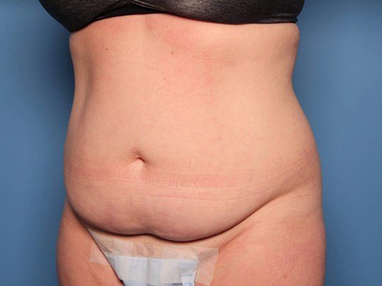 before tummy tuck diagonal view sarasota plastic surgery