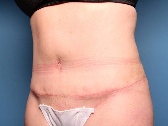 after tummy tuck diagonal view sarasota plastic surgery
