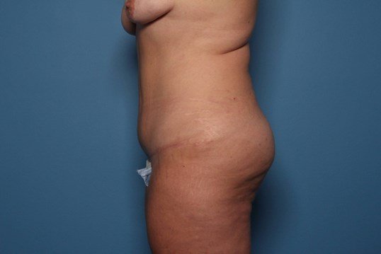 after tummy tuck side view sarasota plastic surgery