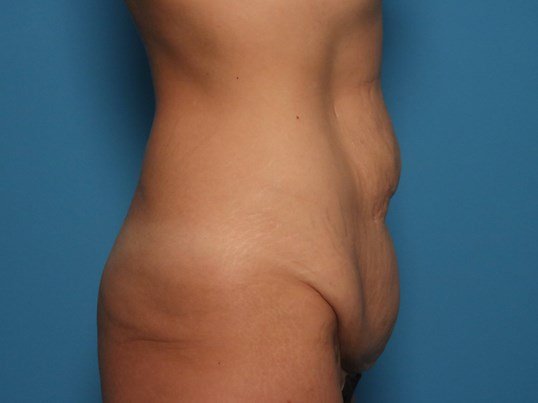 before tummy tuck side view sarasota plastic surgery