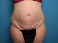 before tummy tuck front view sarasota plastic surgery