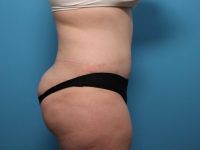 after tummy tuck side view sarasota plastic surgery