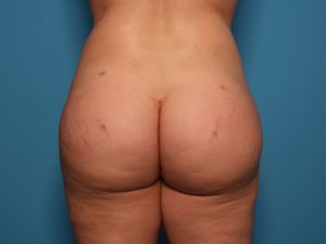 After brazilian butt lift back Sarasota Plastic Surgery Center