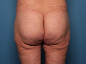 After brazilian butt lift back Sarasota Plastic Surgery Center