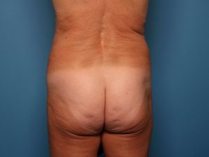 Before brazilian butt lift back Sarasota Plastic Surgery Center