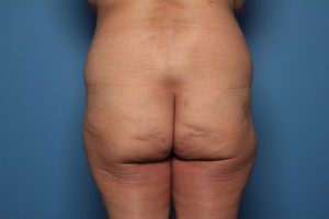 Before brazilian butt lift back Sarasota Plastic Surgery Center