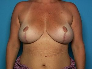 After breast reduction front Sarasota Plastic Surgery Center