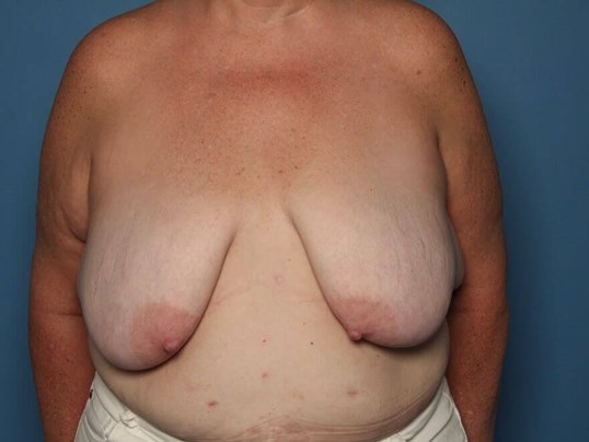 Before breast reduction front Sarasota FL
