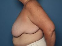 Before breast reduction side Sarasota Plastic Surgery Center