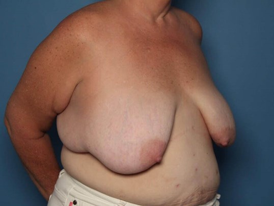 Before breast reduction angle Sarasota FL