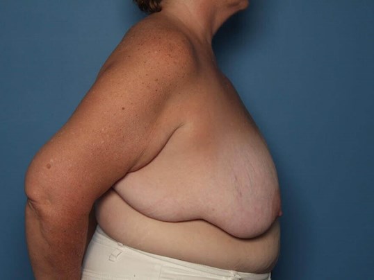 Before breast reduction side Sarasota Plastic Surgery Center