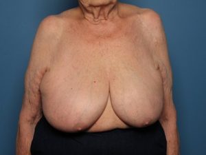 Before breast revision front Sarasota Plastic Surgery Center