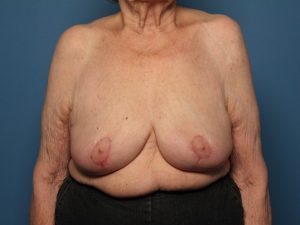 After breast revision front Sarasota Plastic Surgery Center
