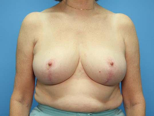 After breast revision front Sarasota Plastic Surgery Center