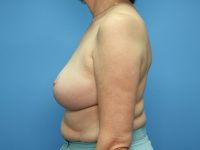 After breast revision side Sarasota Plastic Surgery Center