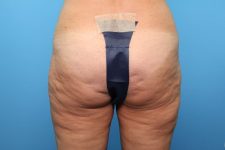 After liposuction front Sarasota Plastic Surgery Center