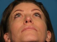 After rhinoplasty Sarasota Plastic Surgery Center