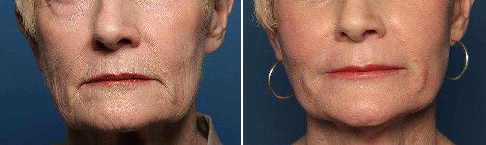 Before and after facial fat grafting
