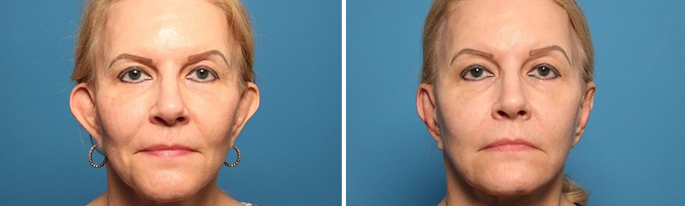 Before and after otoplasty
