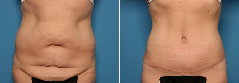 Before and after tummy tuck
