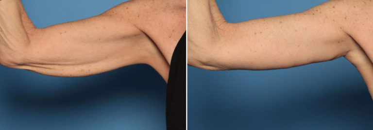 Before and after arm lift
