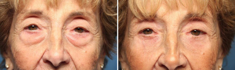 Before and after eyelid surgery