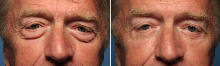 Before and after eyelid surgery